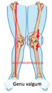 Explications de la douleur au genou